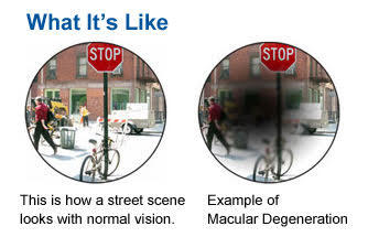 two images comparing macular degeneration